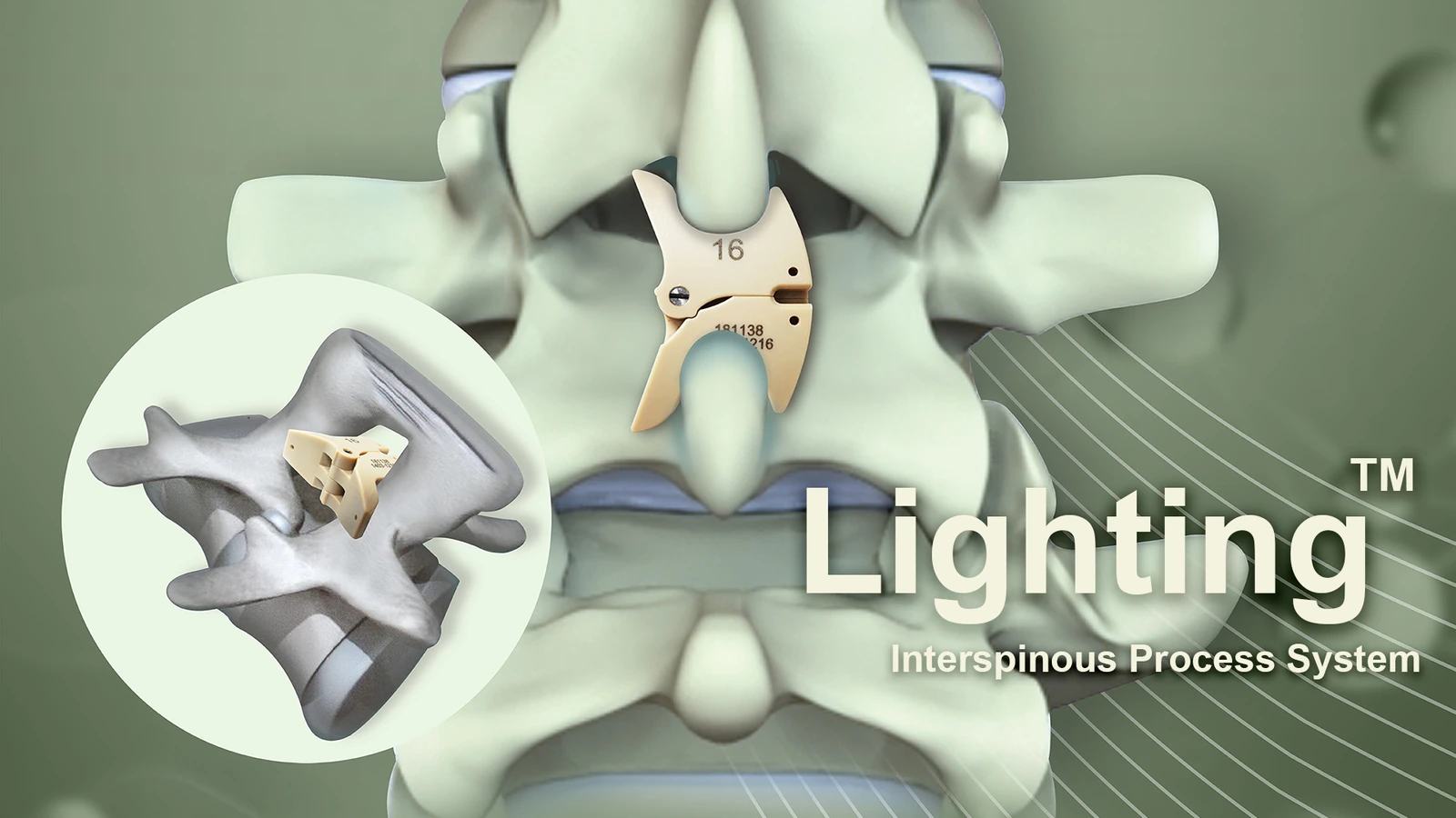 Lighting Interspinous Process System
