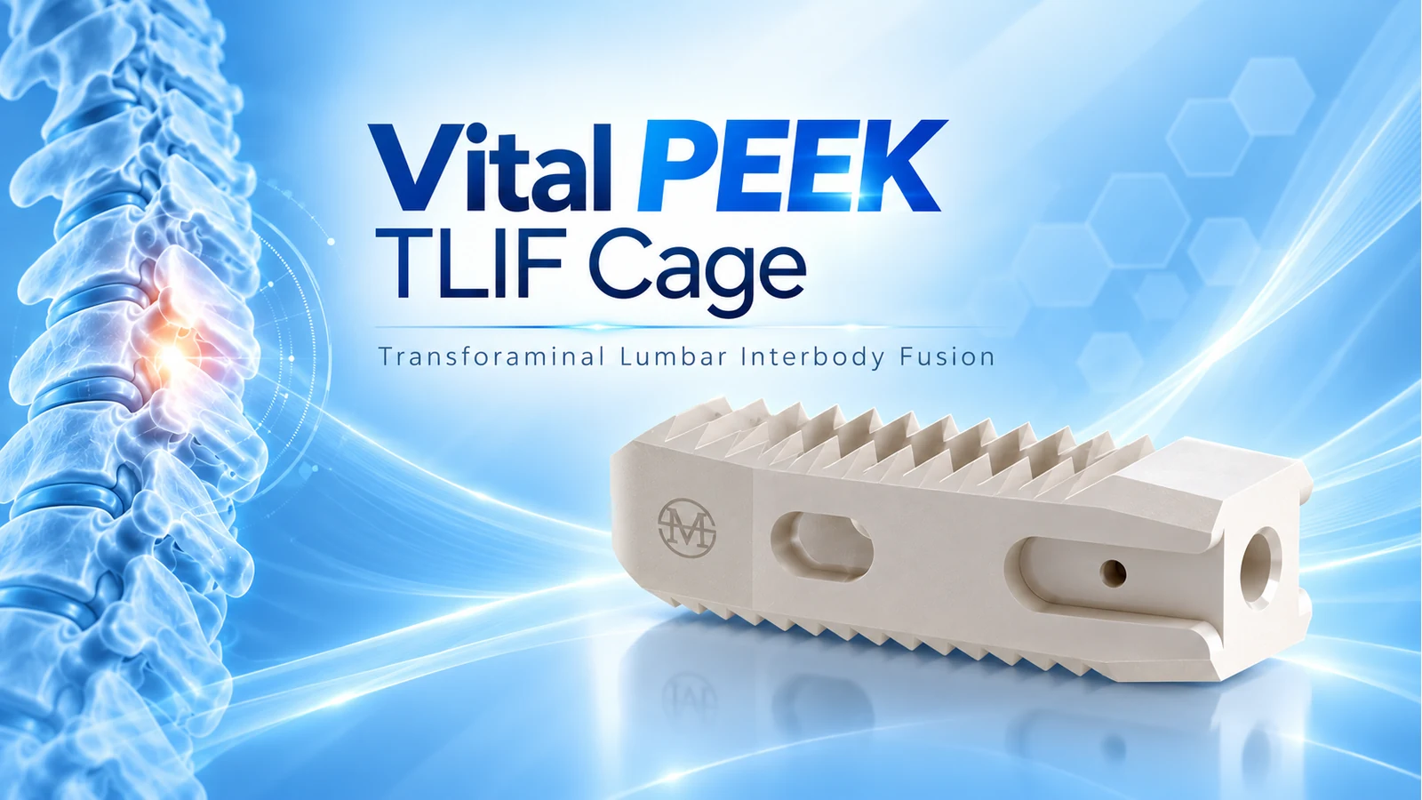 Vital PEEK TLIF Cage
