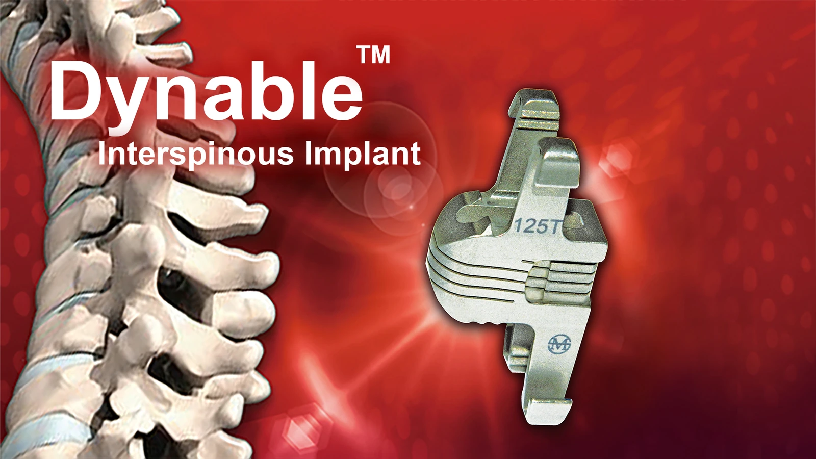 Dynable Interspinous Implants