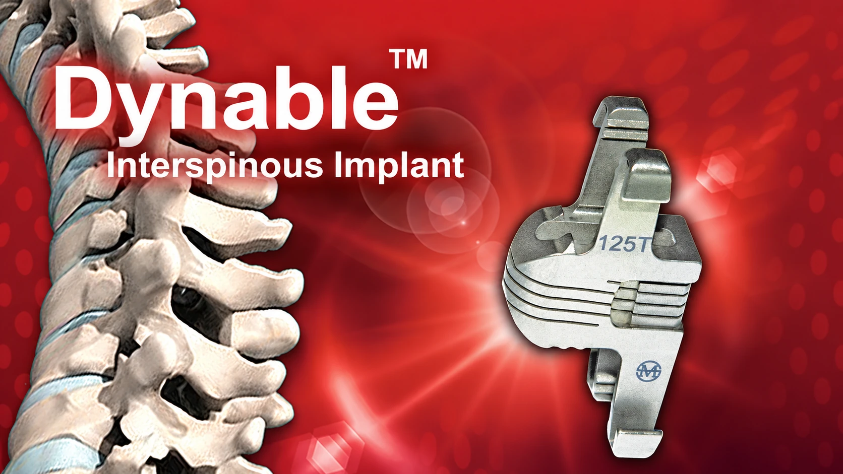 Dynable interspinous implant poster